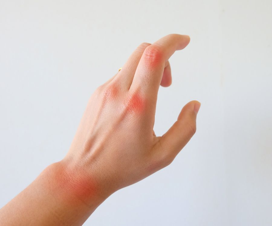 artrite reumatoide me donna salute (1)