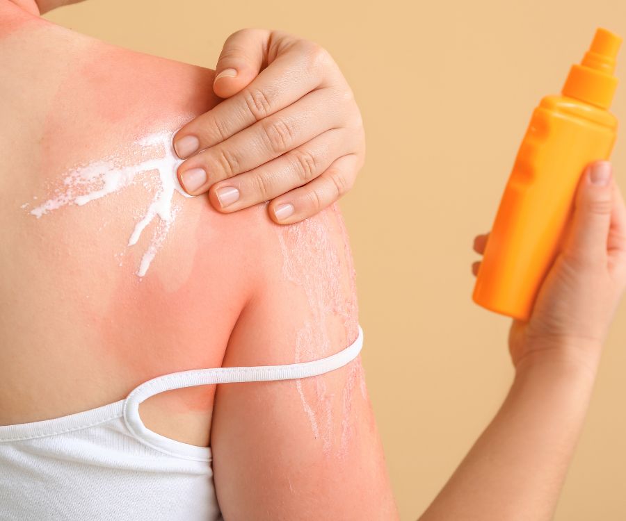 creme per scottature solari me donna salute