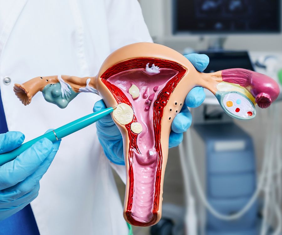 fibroma uterino me donna salute