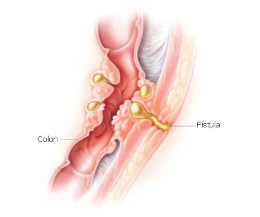 Fistole retto-vaginali me donna salute