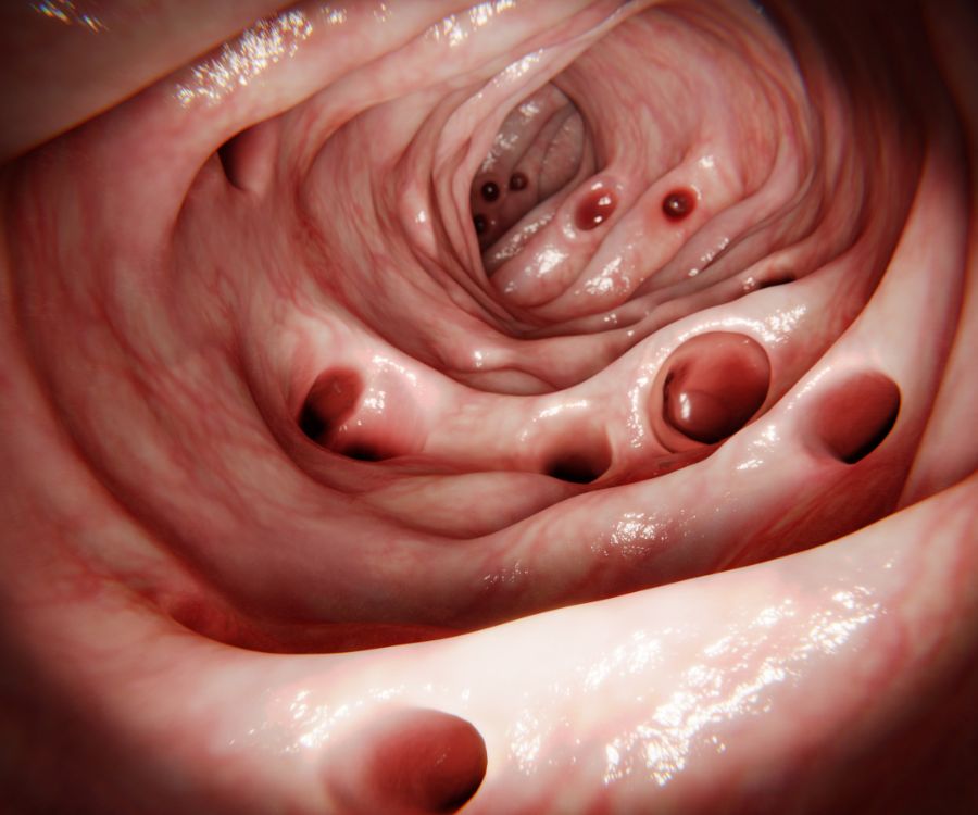 diverticoli uretrali me donna salute