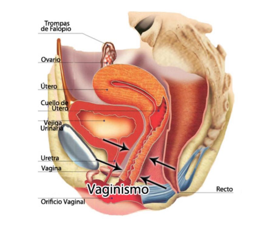 vaginismo me donna salute
